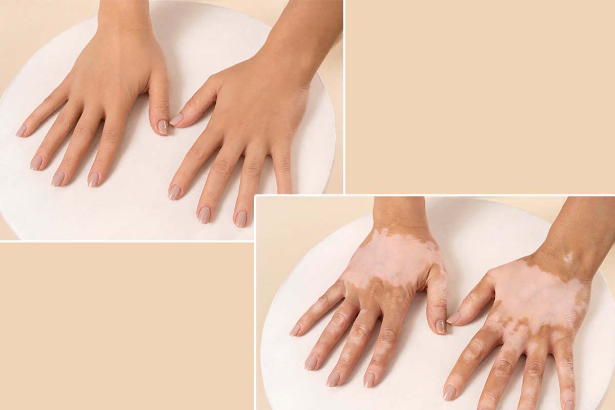 Vitiligo Camouflage